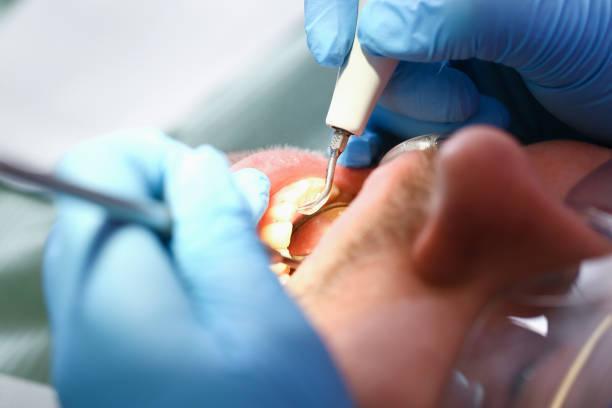 Best Emergency Dental Care for Sports Injuries in Spencerville, MD